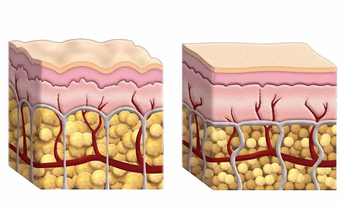 Cellule adipose durante l'uso del guru keto