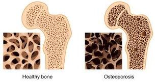 osteoporosi ossea